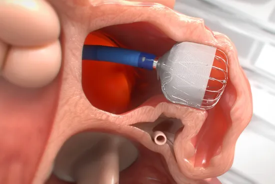 photo of left atrial appendage closure