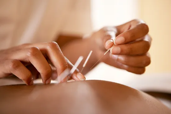 photo of acupuncture