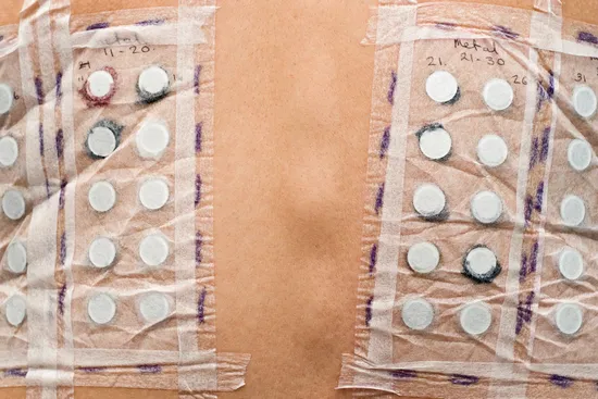 photo of Patch test for skin