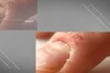 photo of fingernails with psoriasis