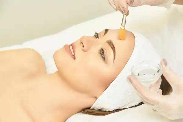 photo of chemical peel