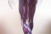photo of dvt