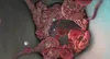blood clot illustration